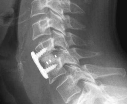 acdf cervical plate anterior discectomy surgery done