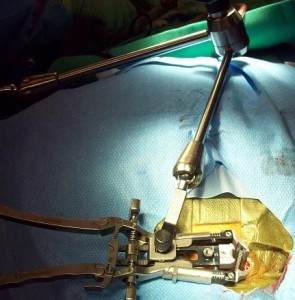 surgical approach using tissue dialators to open the skin and muscle without cutting. Cervical Retractor system in place 