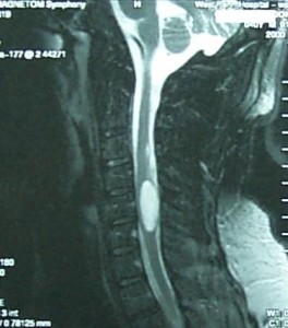 Cervical Spinal Cord Tumor
