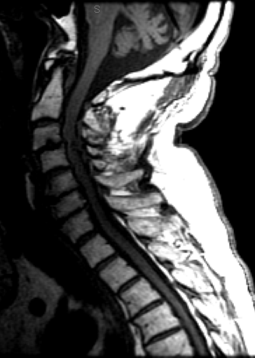 Cervical Spine 2