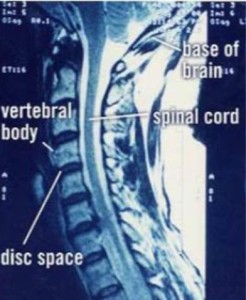 Cervical Spine Labeled