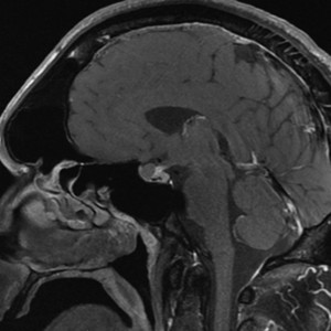 Pituitary Tumor sag preop