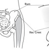 Iliac Crest