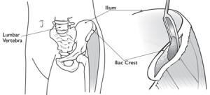 Iliac Crest