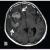 Using Diet to Help Treat Cancer Brain Tumor