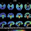 PET Scan CTE