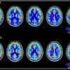 Maroon Brain MRI changes B & A HBOT