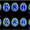 HBOT blood flow scan